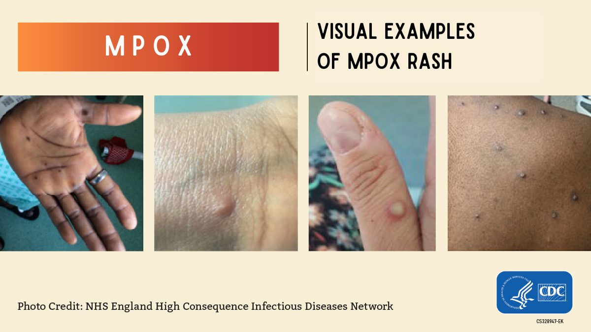 Mpox | Visual examples of mpox rash. Four photos of mpox rash on different parts of the body: hand, wrist, thumb, shoulders. Photo credit: NHS England High Consequence Infectious Disease Network. Branded with Centers for Disease Control and Prevention logo. 